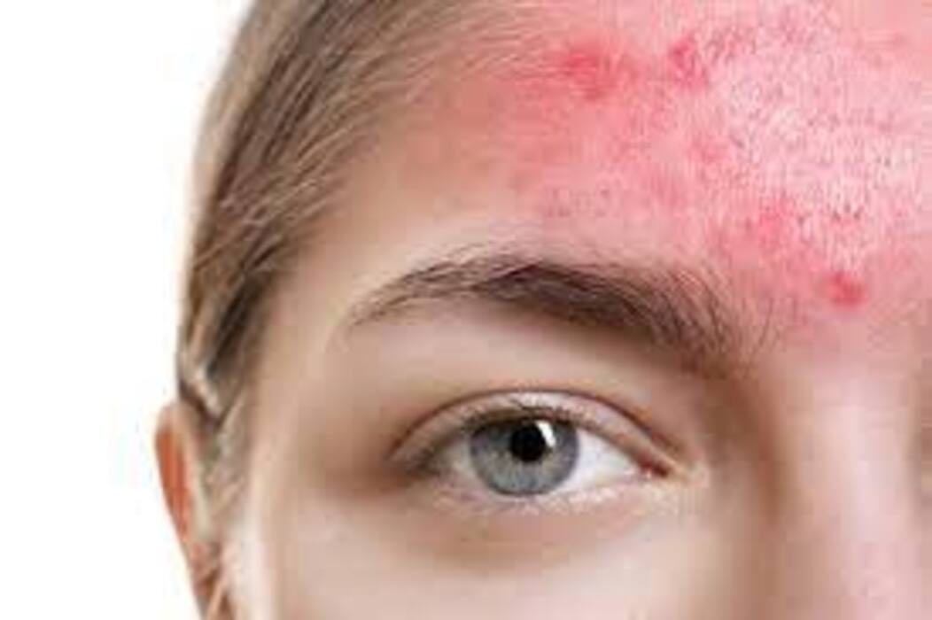 Scaly Patches To Burning Sensation: Beware of THESE 5 Warning Symptoms of Severe Skin Diseases