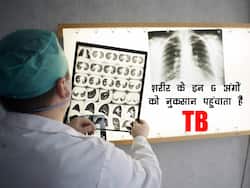 फेफड़ों के अलावा शरीर के इन 6 अंगों को भी अपना शिकार बना सकता है TB, बचाव के लिए करें ये उपाय