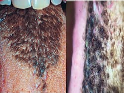 Indian Man   s Tongue Turns Black And Hairy After Stroke: Doctors Explain The Cause