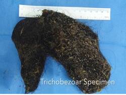 Doctors Remove A Huge Hairball From The Stomach Of A Girl Diagnosed With Gastro Trichobezoar