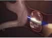 Bronchoscopic Thermal Vapor Ablation (BTVA) Offers New Hope For COPD Patients: All About This Treatment