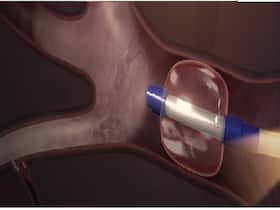 Bronchoscopic Thermal Vapor Ablation (BTVA) Offers New Hope For COPD Patients: All About This Treatment Bronchoscopic Thermal Vapor Ablation (BTVA) Offers New Hope For COPD Patients: All About This Treatment