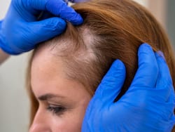 Suffering From Alopecia? Manage Massive Hair Fall With These Ayurveda Remedies