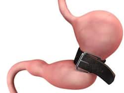 Bariatric Surgery And Mental Health: Exploring The Psychological Impact Of Weight Loss Procedures