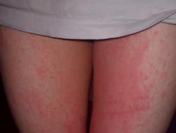 Understanding And Preventing Chafing, A Common Yet Unspoken Skin Issue Among Women