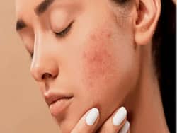 Don't Ignore Facial Redness! It Could Be A Sign Of A Serious Skin Condition