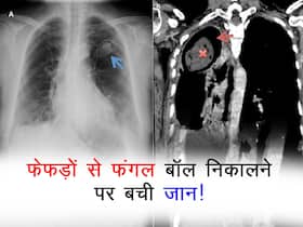टीबी के इलाज के 2 साल बाद बनी फेफड़ों में फंगल बॉल! कफ में खून के बाद सर्जरी से बची जान, पढ़ें पूरी कहानी
