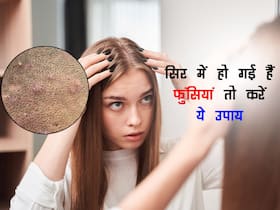 Scalp Acne: इन कारणों से सिर में भी होने लगती हैं फुंसियां, घर की इन इन सिंपल चीजों से करें इलाज Scalp Acne: इन कारणों से सिर में भी होने लगती हैं फुंसियां, घर की इन इन सिंपल चीजों से करें इलाज