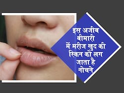 Skin Picking Disorder में व्यक्ति अपनी ही स्किन को लगता है नोचने, जानें अचानक से होने वाली इस बीमारी के लक्षण व इलाज
