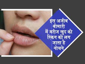Skin Picking Disorder में व्यक्ति अपनी ही स्किन को लगता है नोचने, जानें अचानक से होने वाली इस बीमारी के लक्षण व इलाज