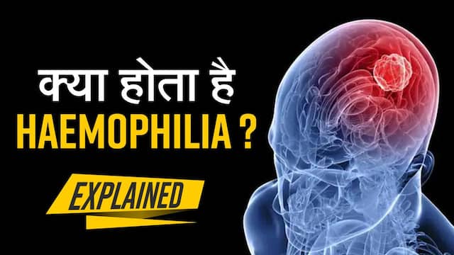 Hameophilia Symptoms: हीमोफीलिया क्या हैं? यह बच्चों को कैसे करता है प्रभावित?