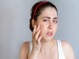Acne During Summer: Causes And How To Prevent It