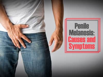 penile melanotic macule a) Pearly papules, projecting as papillae arising from a common Dark-Colored Lesions: Brown, Blue, Gray,