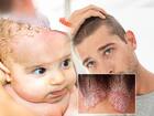 सेबोरिक डर्मेटाइटिस (Seborrheic Dermatitis)