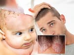 सेबोरिक डर्मेटाइटिस (Seborrheic Dermatitis)