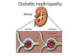 Diabetic nephropathy