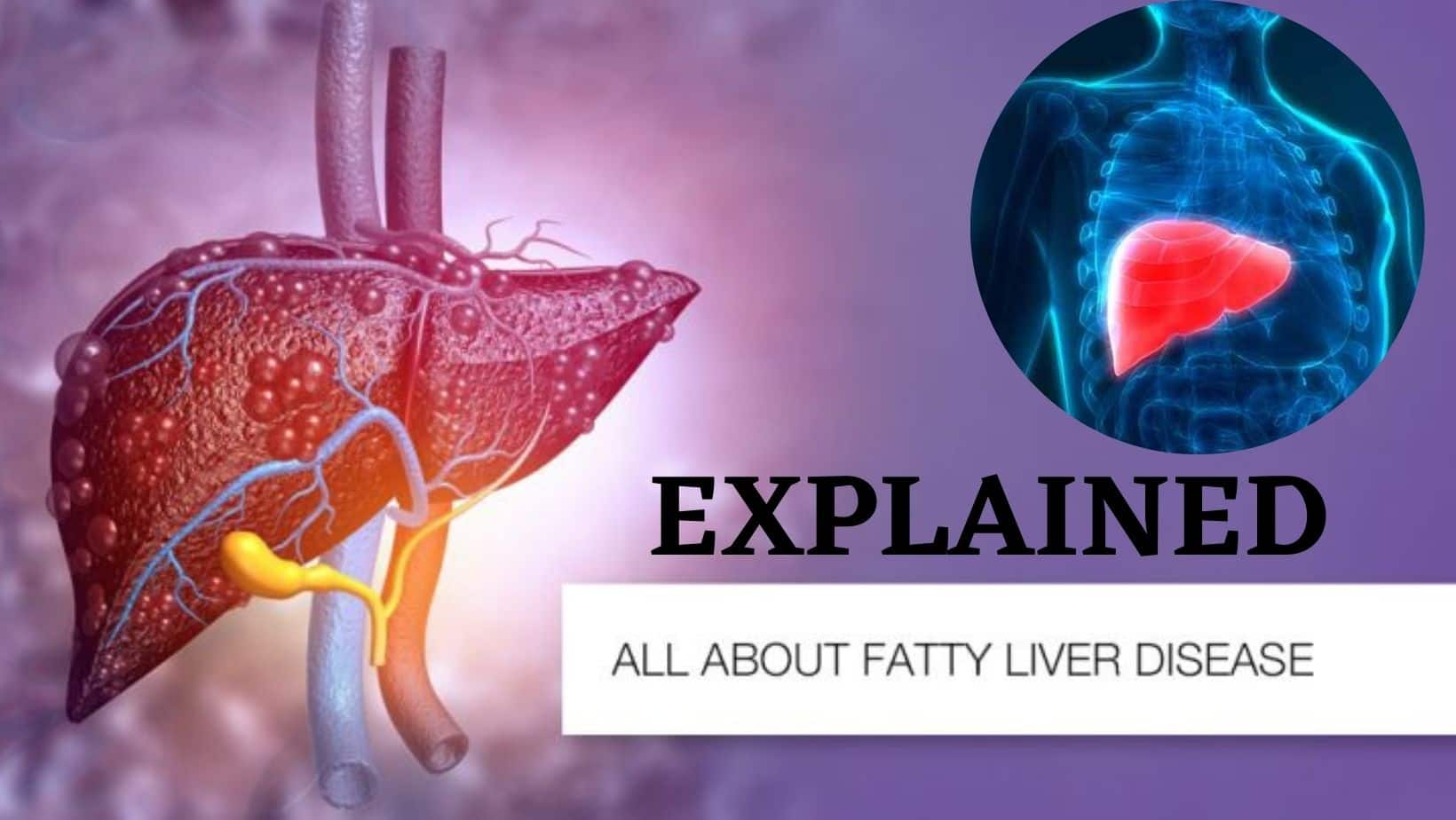 Fatty Liver Disease