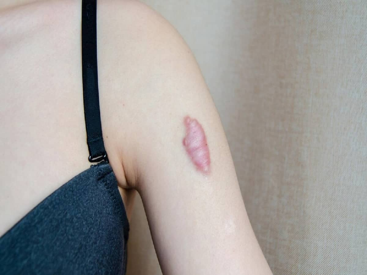 Keloid Tattoo When Scars Form Tattooing Over Keloids More