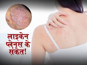 Skin Diseases: इस बीमारी में स्किन का रंग हो जाता है बैंगनी, शुरू में होते हैं ऐसे लक्षण