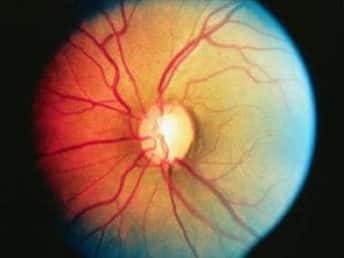Open-angle glaucoma