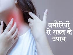गर्मियों में जब सताए घमौरियां तो राहत के लिए आजमाएं ये 2 नेचुरल चीजें, खुजली और जलन से भी मिलेगा छुटकारा