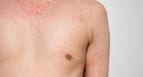 Rubella
