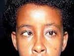 Strabismus