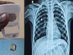 6-Year-Old Boy   s Accidentally Swallows His Loose Tooth, Gets Stuck In The Right Lung
