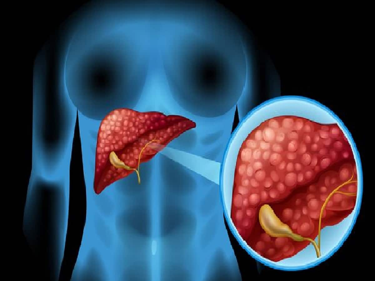 enlarged liver