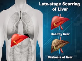 Non-Alcoholic Fatty Liver Disease Is Often Missed In Routine Medical Screening: Do Not Ignore These 5 Symptoms Non-Alcoholic Fatty Liver Disease Is Often Missed In Routine Medical Screening: Do Not Ignore These 5 Symptoms