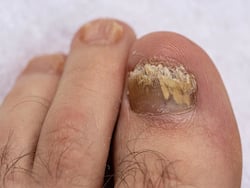 Hot And Humid Weather Leading To Spike In Fungal Infections: Warn Doctors