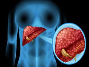 About 30% Of The Population In India Have Fatty Liver Disease: Doctors