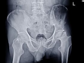 Avascular Necrosis On The Rise Among COVID-Recovered Patients: Steroid Treatment Suspected To Be The Cause Avascular Necrosis On The Rise Among COVID-Recovered Patients: Steroid Treatment Suspected To Be The Cause