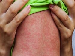 UNICEF, WHO Warn Of Worldwide Measles Outbreaks, Affecting Children