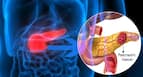 Pancreatic cancer