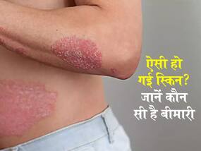 Psoriasis symptoms: शरीर वर लाल रंग के जलन भरे धब्बे हैं स्किन की इस बीमारी का संकेत! जानें किन लक्षणों पर ध्यान पर न देने से खराब होने लगती है स्किन