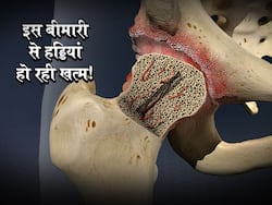 Avascular-necrosis : हड्डियों को खत्म करने का काम कर रही है ये बीमारी! 'डेथ ऑफ बोन' से रुक जाती है खून की स्पलाई, जानें लक्षण