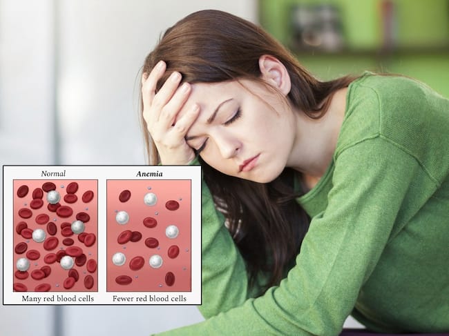 anaemia
