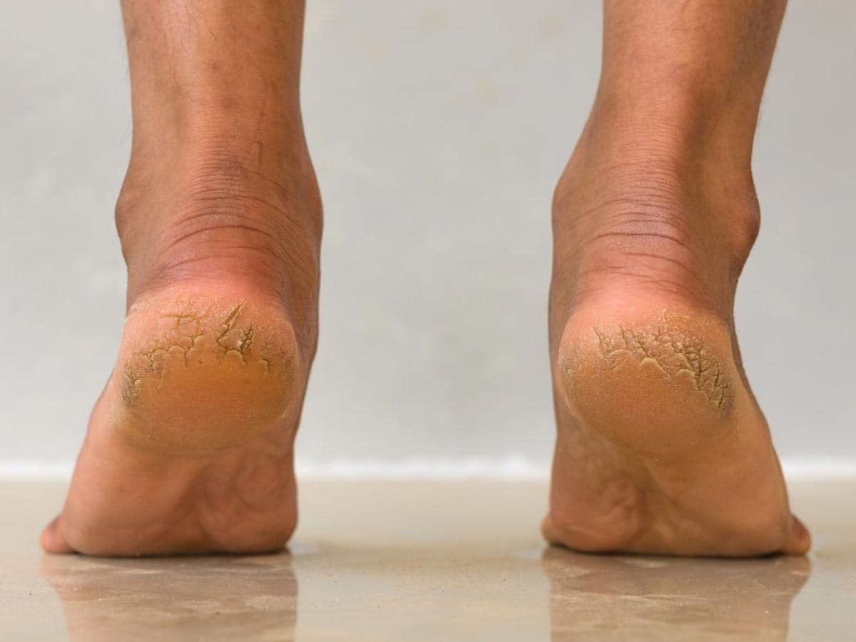 Cracked feet hi-res stock photography and images - Alamy