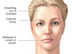 Bell's Palsy