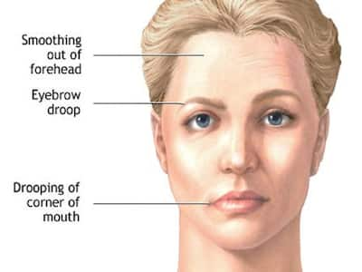 Facial Paralysis: Can Covid-19 Vaccination Cause Bell's Palsy ...