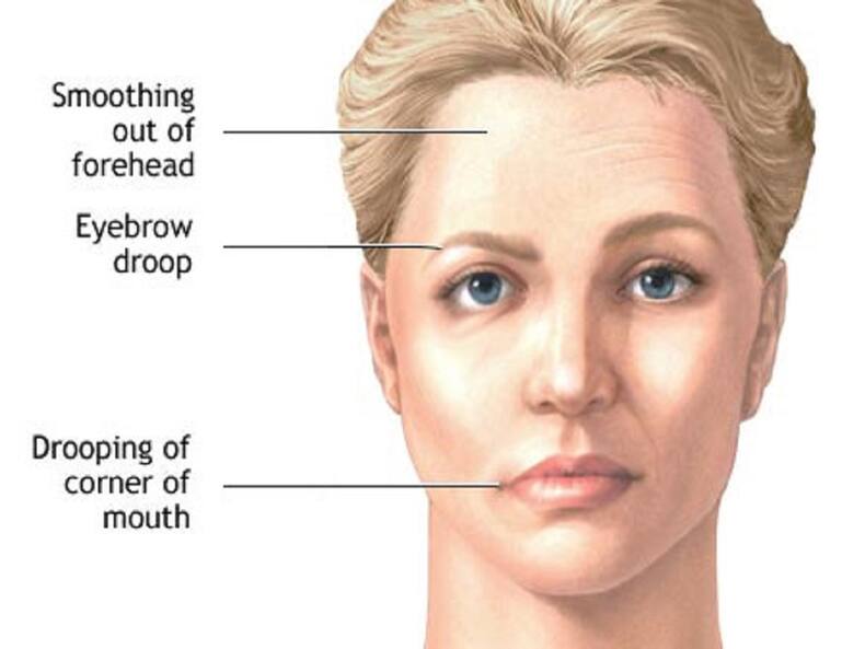 bells-palsy