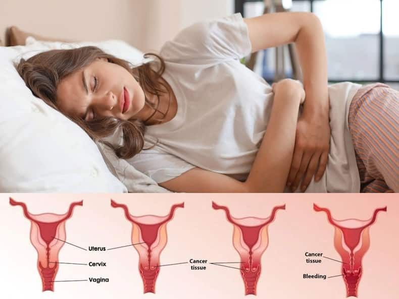 cervical-cancer