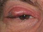 Chalazion