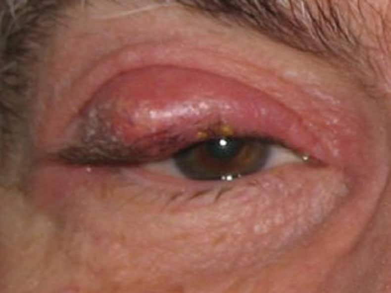 chalazion