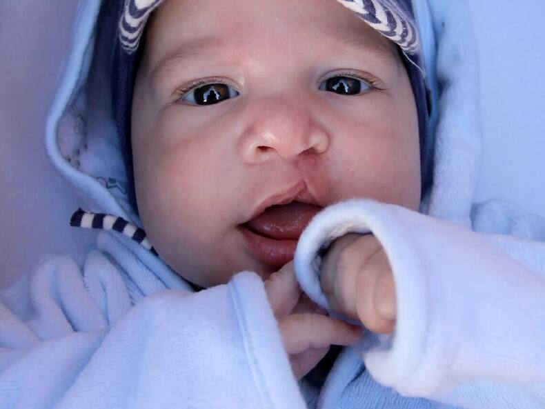 cleft-lip-and-palate