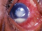 Corneal ulcer