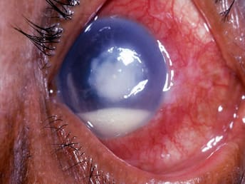 Corneal ulcer