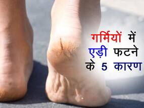 इस विटामिन की कमी से हमेशा फटी रहती हैं आपकी एड़ियां, जानें गर्मियों में एड़ी फटने के 5 कारण
