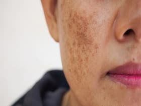 Are Sunspots Dangerous? 4 Therapies To Get Rid Of Them Are Sunspots Dangerous? 4 Therapies To Get Rid Of Them